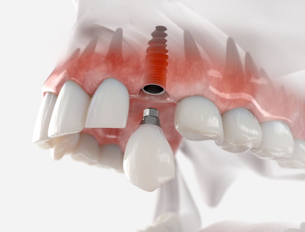 dental implant Ellicott City, MD