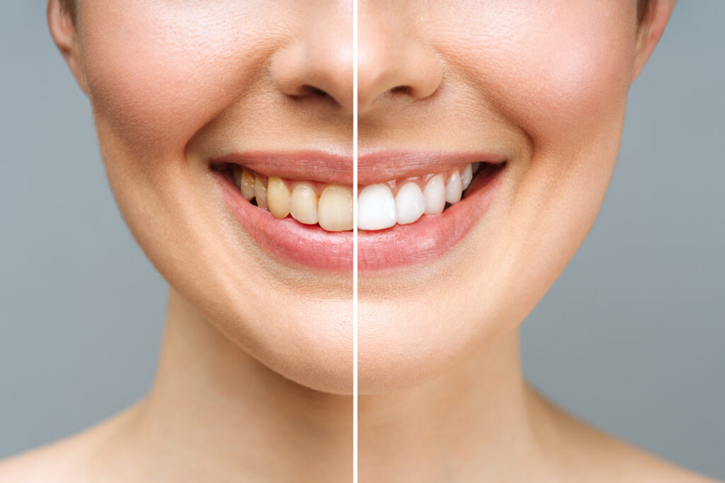 teeth whitening in Ellicott City, MD