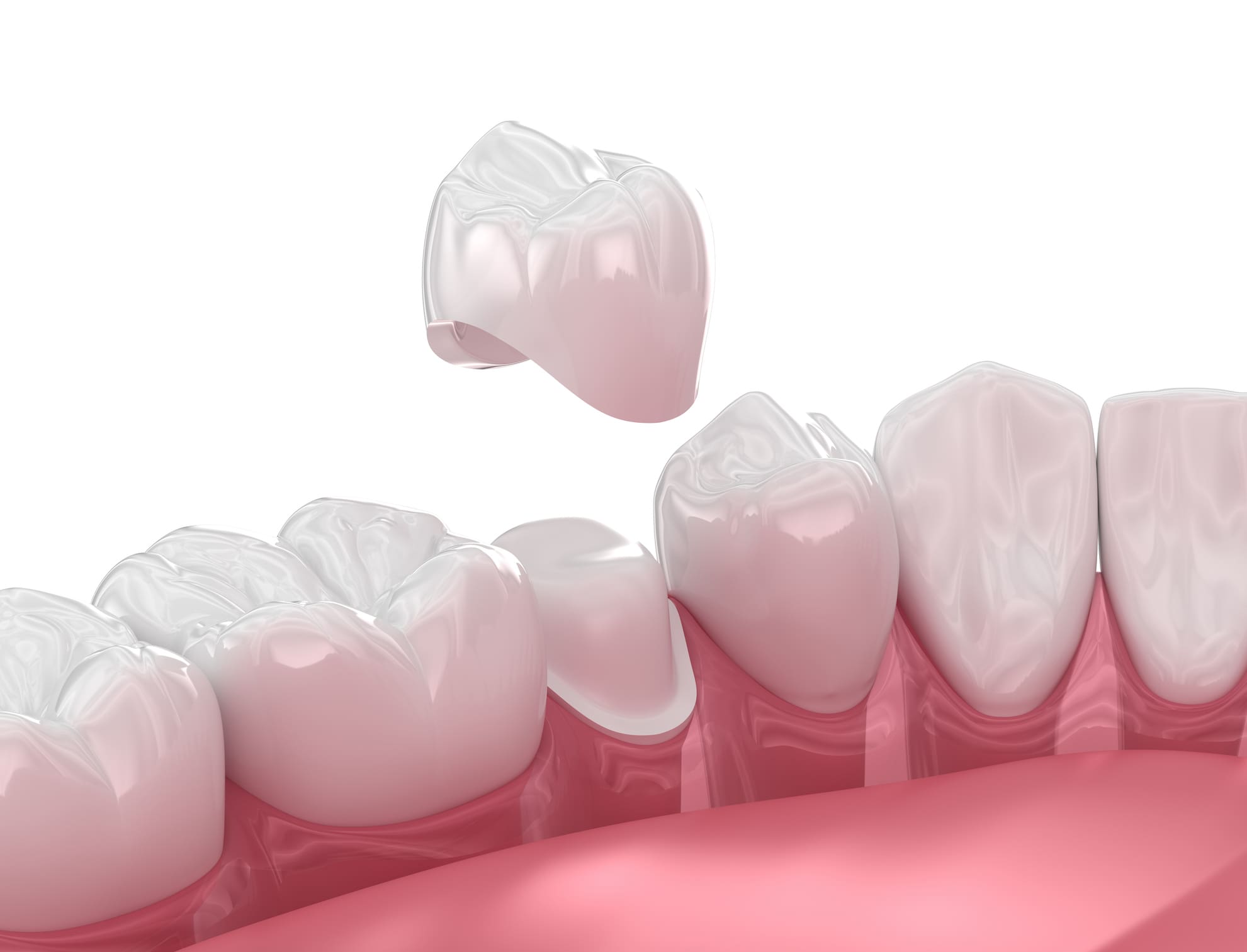 Dental crowns in Ellicott City, MD